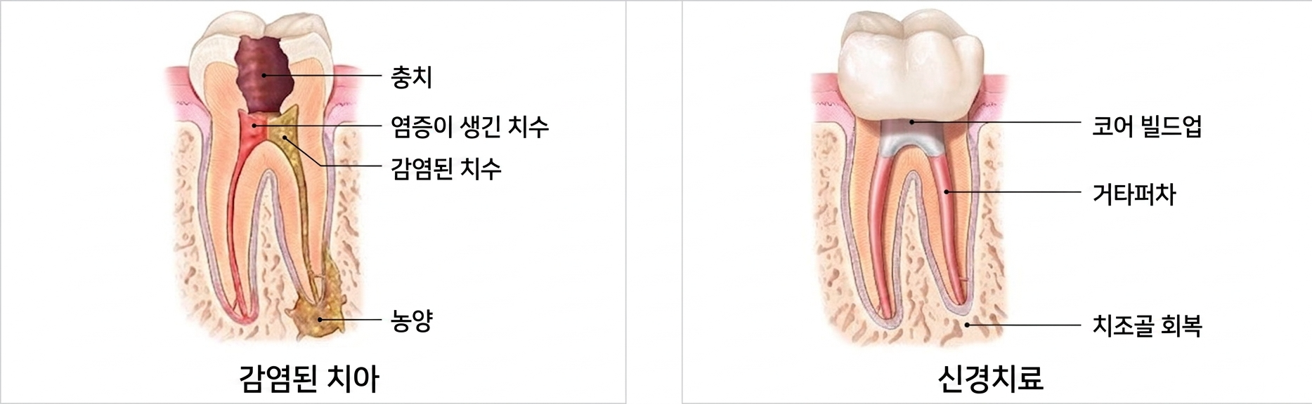 신경치료  후 크라운이 필요한 이유. 앞니와 어금니 완전 분석